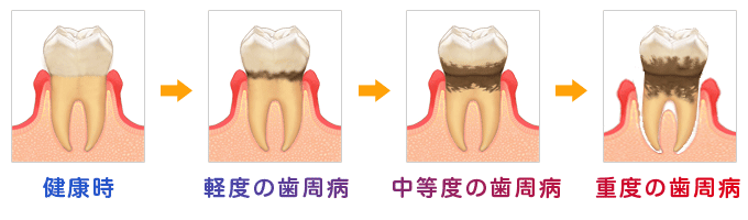歯周病の進行イラスト